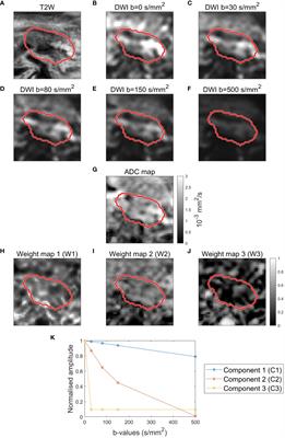 Prediction of overall survival in patients with locally advanced pancreatic cancer using longitudinal diffusion-weighted MRI